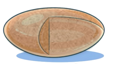 Illustration of a cloudy, cataract-affected lens.